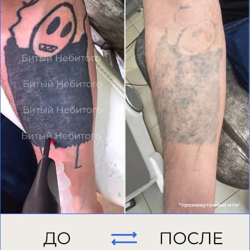 Удаление татуировки